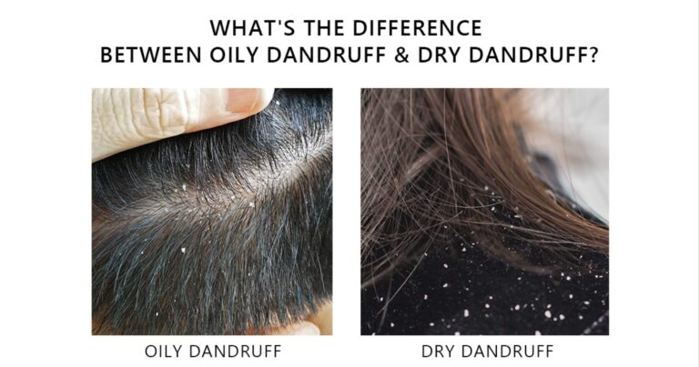 Oily Scalp vs Dry Scalp: Which Causes Hair Loss